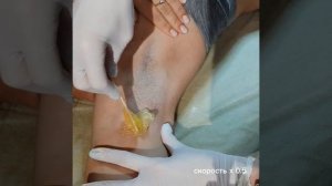 Шугаринг шпателем. Подмышки.