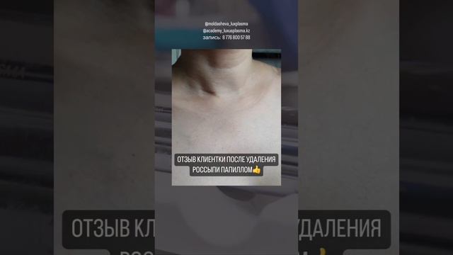 Отзыв после удаления россыпи папиллом аппаратом LuxusPlasma🔥Запись по номеру ватсап:📱8 776 800 57 8