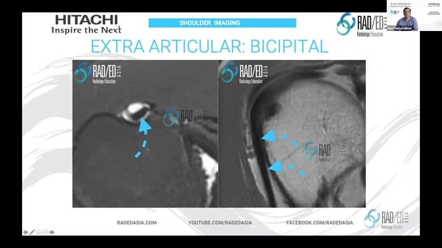 MRI Online Review Learn MSK MRI Radiology :MRI Shoulder Radiology. Biceps Tendon MRI Part 1