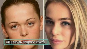 Анна Хилькевич призналась, какую пластику делала