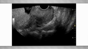 Патологические изменения плода, выявляемые при скрининге 1-го триместра беременности