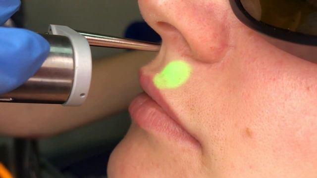 Лазерна епіляція зони ліца без болю ? смотреть онлайн