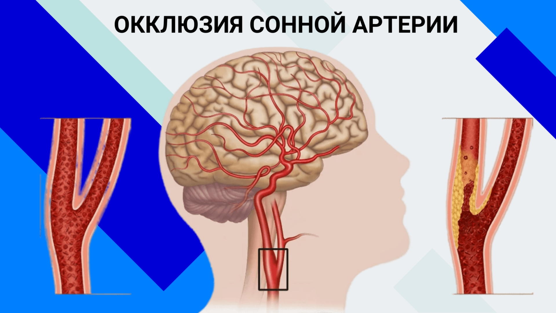 Тромбы сосудов головного мозга. Окклюзия сонной артерии. Окклюзия сосудов Сонный артерия. Стентирование сонной артерии.