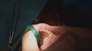 Циркониевая коронка на имплант 4.6 Обучающее видео для вр.интернов. 3ч. 4-я стоматология. 22.11.202