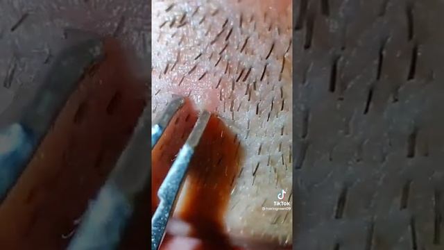 Удаление вросшего волоса