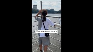 После снятия гипса