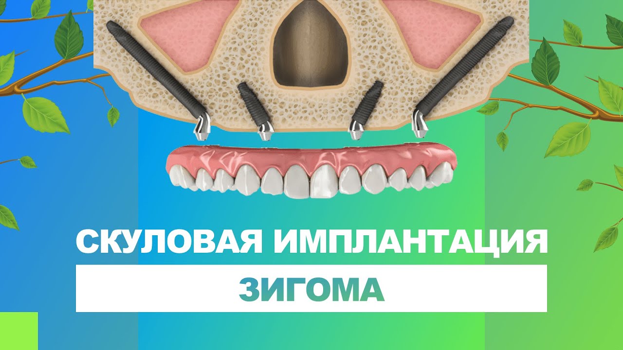 ? Скуловая имплантация Зигома - Zygoma