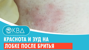? Краснота и зуд на лобке после бритья. Клинический случай №918