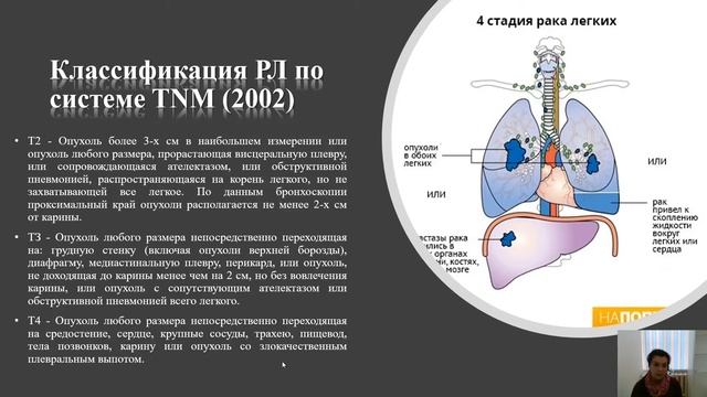 Онкология. Рак лёгкого смотреть онлайн