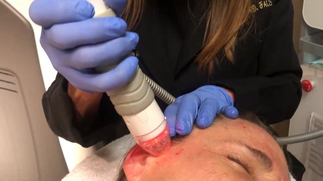 Fractional Microneedling with Radio Frequency & CO2 Laser Treatment - Dr. Christine Petti смотреть онлайн