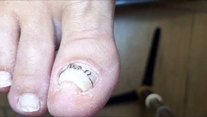 Клещевидные ногти??⚠️?  • Установка титановой нити????