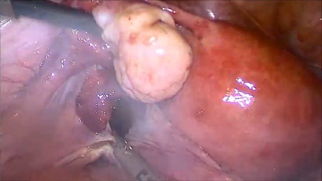 Лапароскопия, удаление кисты малого таза (шеечная лейомиома) смотреть онлайн