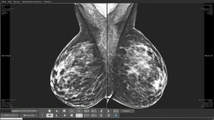 Режим маммографии на АРМ врача-диагноста "Гамма Мультивокс Д1"