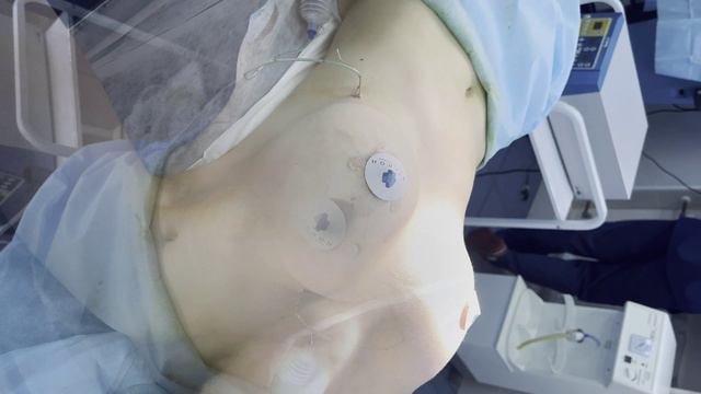 Результат увеличения груди сразу после операции