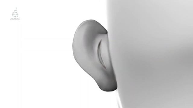 Otoplasty in Turkey (2) Hours - Turk Aesthetic смотреть онлайн