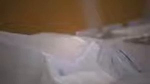 Съемный протез Полный протез