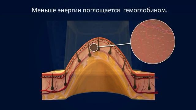 Лазерная эпиляция на аппарате LightSheer® DUET смотреть онлайн