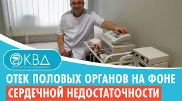 ? Отек половых органов на фоне сердечной недостаточности. Клинический случай №712