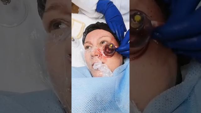 Косметологическая хиджама в прямом эфире!