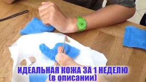 #12 ОГРОМНЫЕ ЧЕРВИ ПОД КОЖЕЙ ДЕВУШКИ, УДАЛЕНИЕ