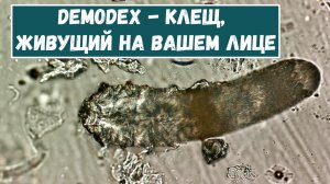 Лицевой клещ - Demodex