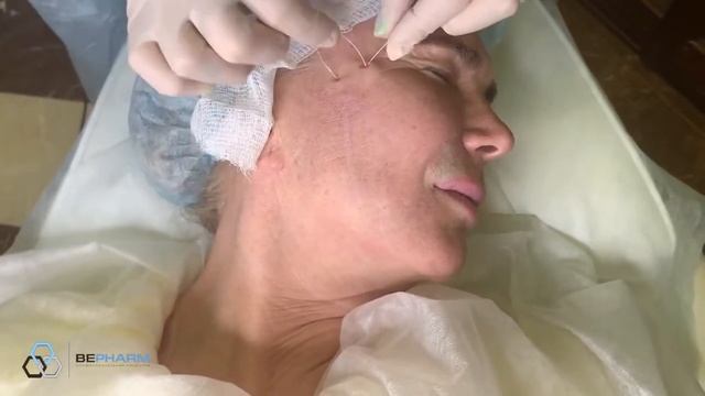 Имплантация армирующих нитей с целью лифтинга средней и нижней трети лица смотреть онлайн