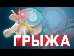 Позвоночная грыжа. Грыжа диска. Что делать? Как лечить?