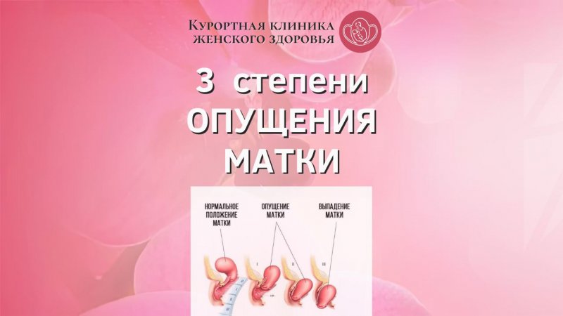 Степени опущения матки. Как определить степень самостоятельно?