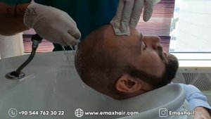 ПЕРЕСАДКА МАКУШКИ В ЕМАХ HAIR ( ГУСТО) 3500 ГРАФТОВ
