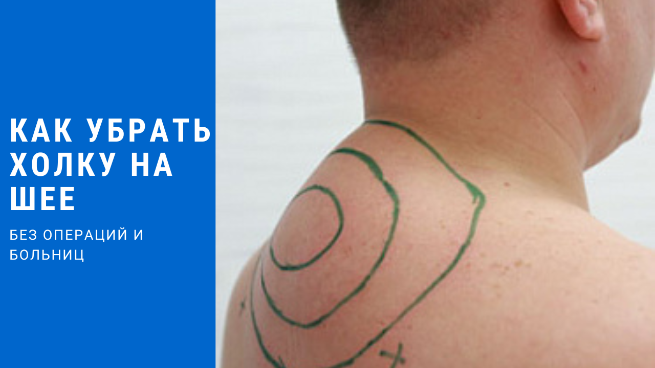 Как убрать холку на шее❗️избавляемся от вдовьего горбика❗️