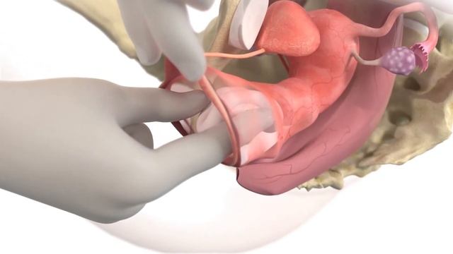 Ring Folding Pessaries смотреть онлайн