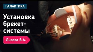 Установка брекет-системы | Львова Виктория