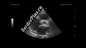 Эхокардиография. Фиброз аортального клапана