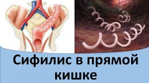 Сифилис в прямой кишке.