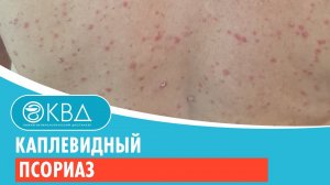 ? Каплевидный псориаз. Клинический случай №213