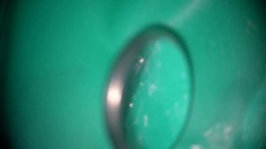 Апексификация - закрытие широкой верхушки корня с помощью МТА