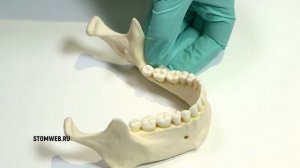 Обезболивание нижнего альвеолярного нерва в области отверсти