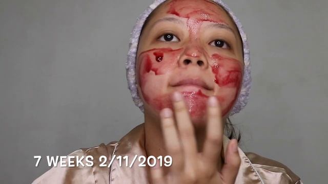 The ordinary peeling solution review (8 weeks) смотреть онлайн