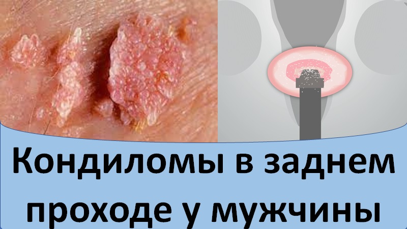 Кондиломы в заднем проходе у мужчины