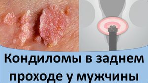 Кондиломы в заднем проходе у мужчины