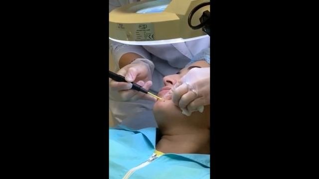 УДАЛЕНИЕ НОВООБРАЗОВАНИЯ НА ЛИЦЕ!!!