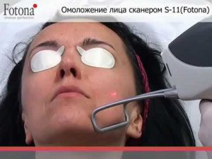Лазерное смус омоложение - Smooth омоложение лазером Fotona