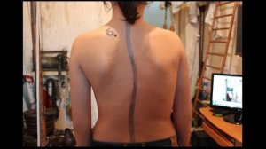 Из невозможного выпрямляю Сколиоз 3 степени