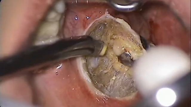 Coblation Tonsillectomy