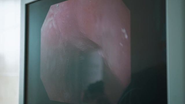 проект Ранняя диагностика синхронного и метахронного рака пищевода у больных с ЗНО глотки смотреть онлайн