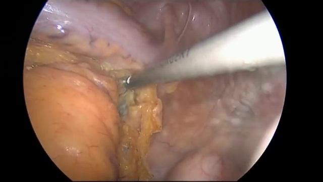 Лапароскопическая резекция сигмовидной кишки смотреть онлайн