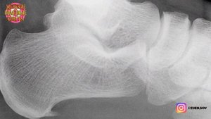 Избавляемся от пяточной шпоры с помощью этих простых и эффективных упражнений!