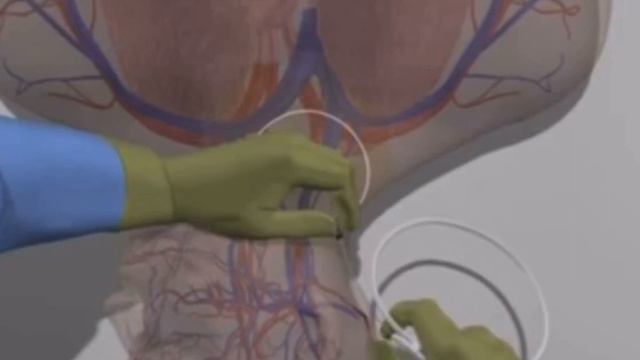 Что делать, если у человека слишком тонкие вены? смотреть онлайн