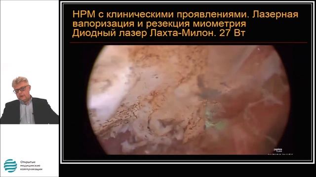 Несостоятельность рубца на матке после кесарева сечения. Диагностика и хирургическая тактика.Лекция смотреть онлайн