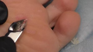 Болячки СТОПЫ.? Что ЭТО выросло? ПУЗЫРИ  на коже. Педикюр ПОДРОБНО. Deep Callus. Глубокая мозоль